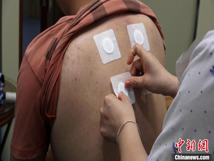 圖為醫(yī)生正在為民眾貼“三伏貼”?！√莆登?攝